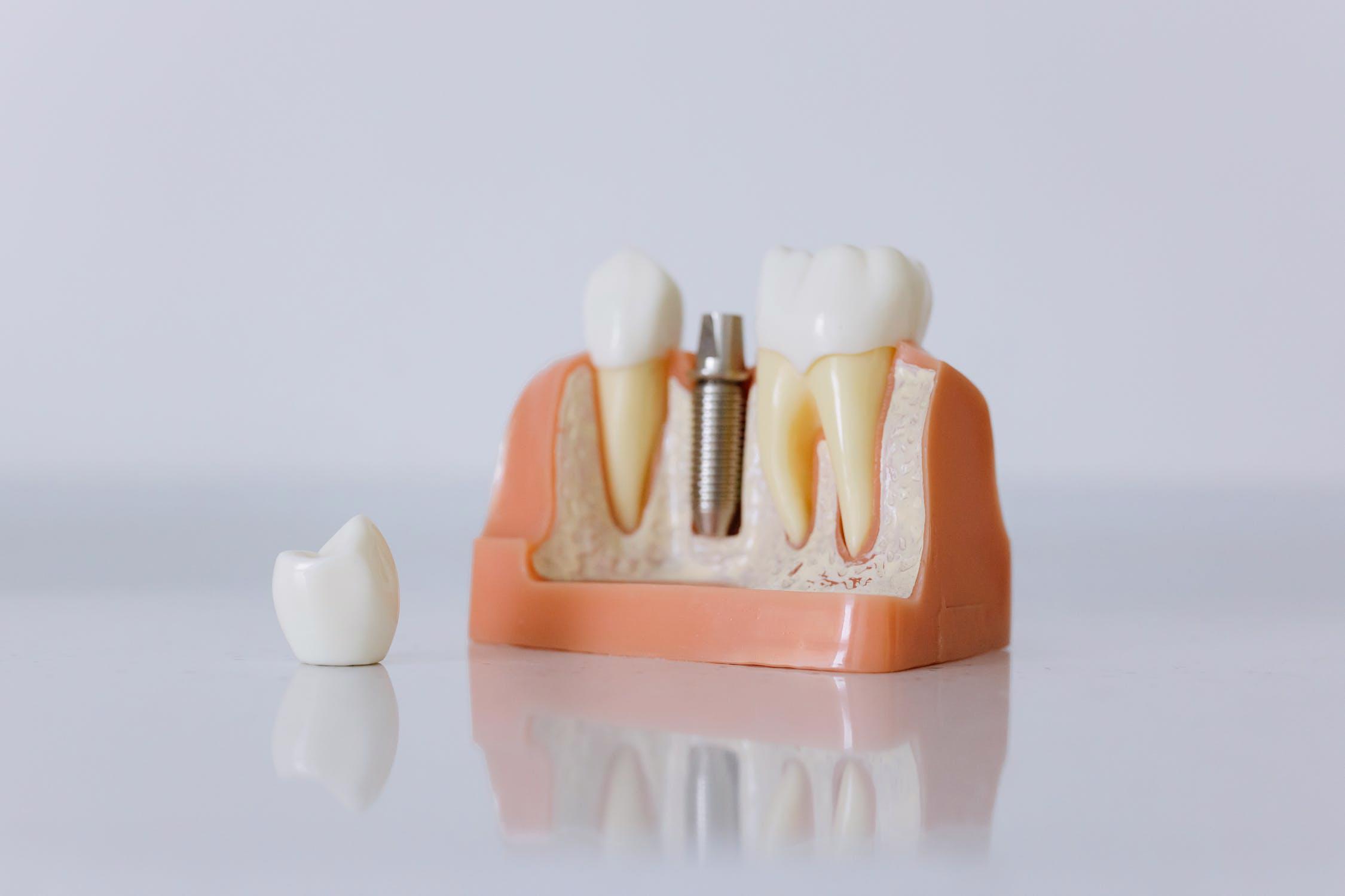 Cauzele unui implant dentar nereusit