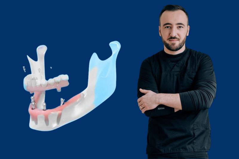 Implant Dentar All-On-4